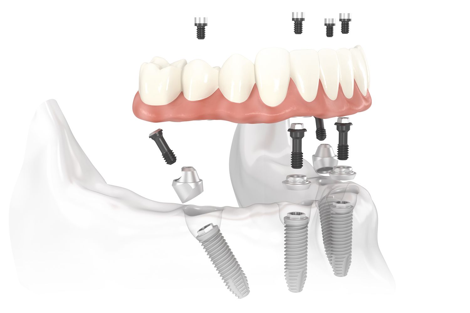 all-on-4 implants installation graphic