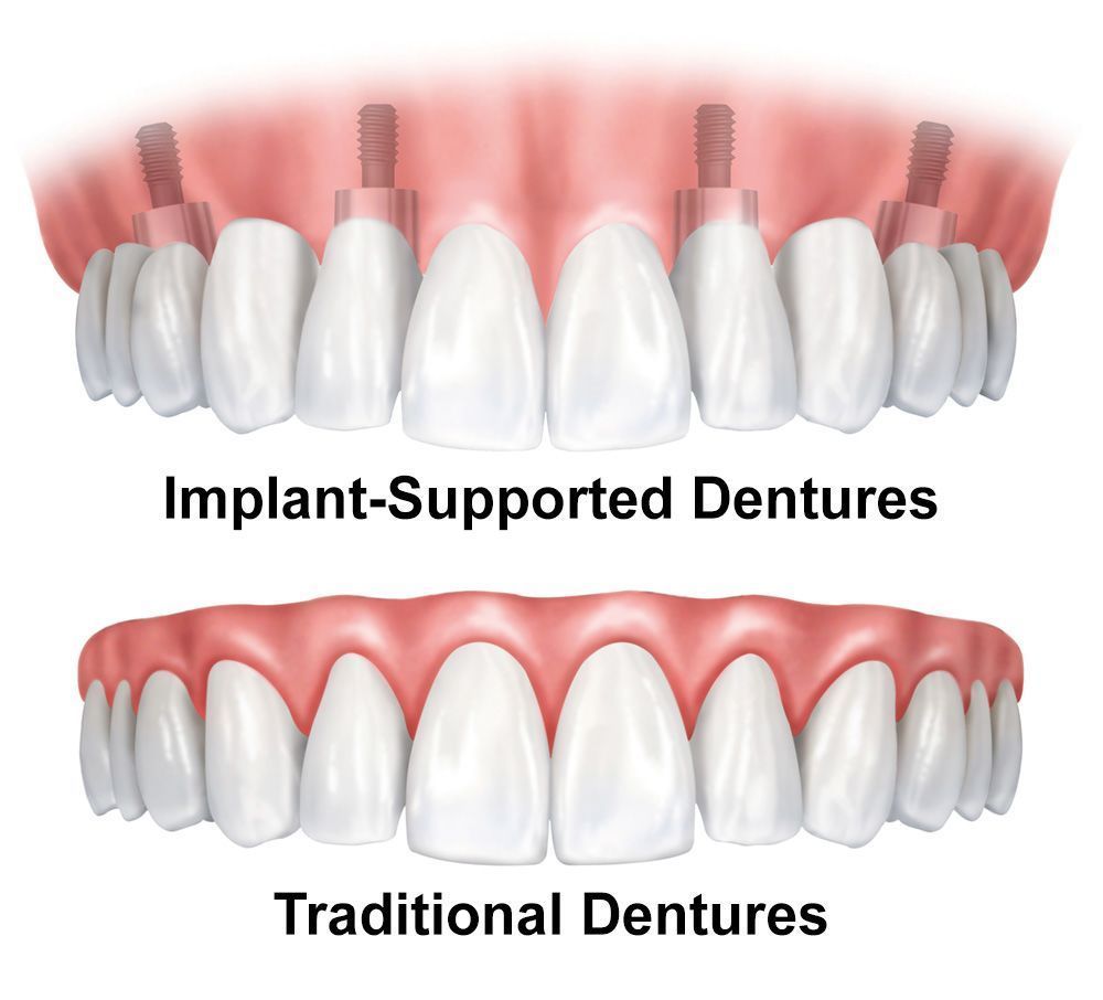 traditional vs. implant-supported dentures