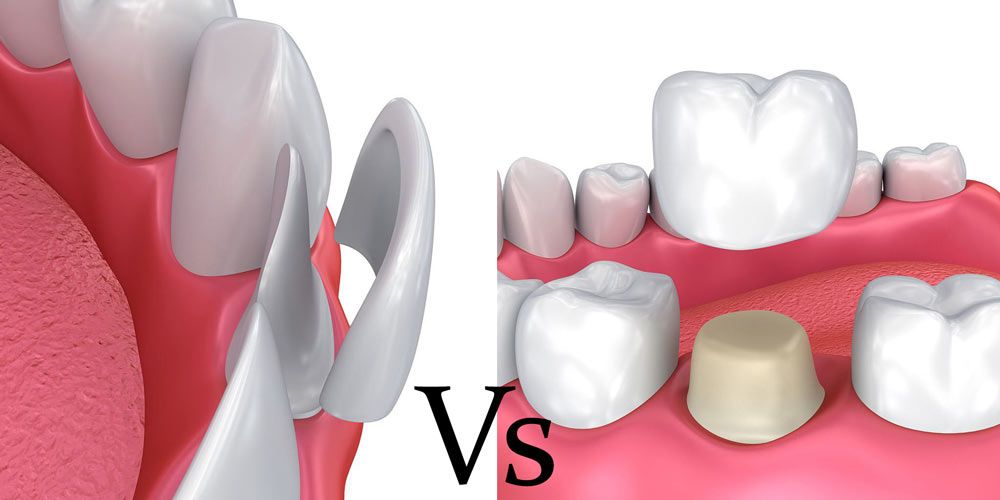 veneers vs crowns