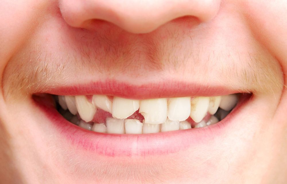 Chipped front teeth